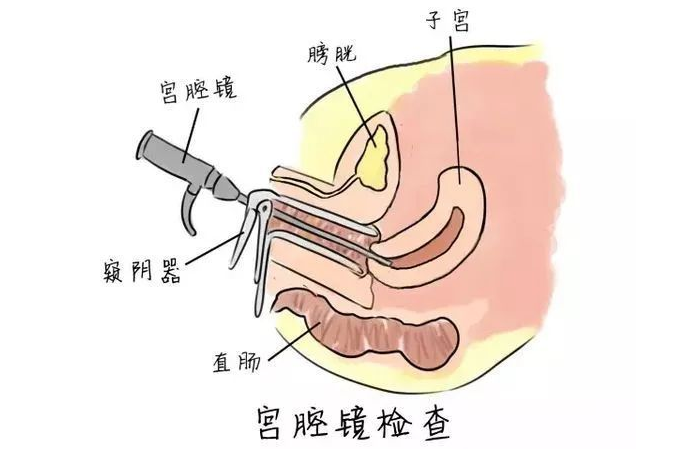 试管婴儿前为什么要做宫腔镜？痛不痛？